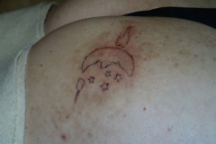 scar